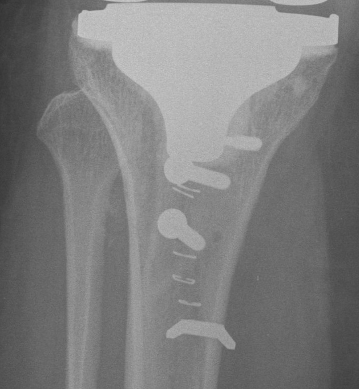 TKR Tibial Tuberosity Transfer AP